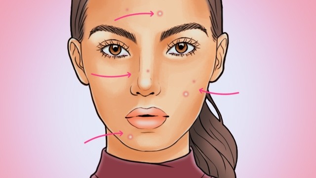 Acne Face Chart