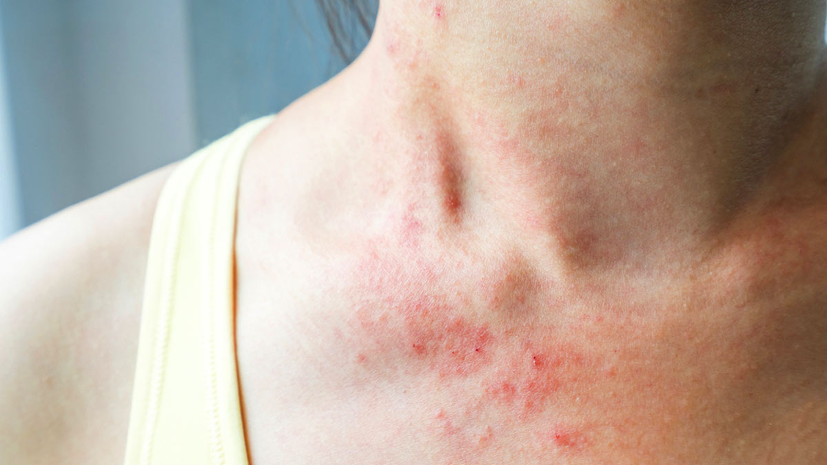 Rashes Could Be A Symptom Of COVID 19