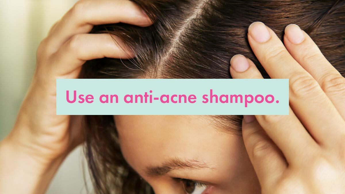 Acne On The Scalp: Causes + Best Treatments