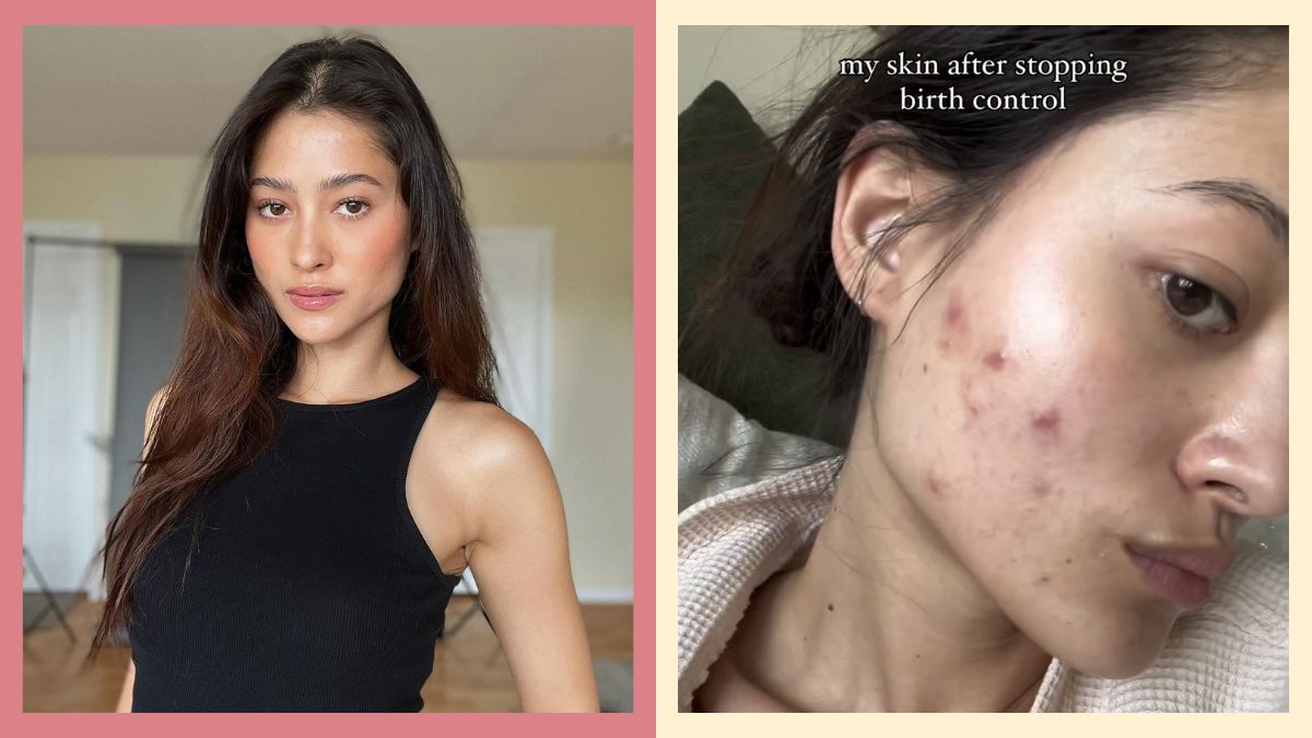 Acne After Stopping Birth Control Treatment