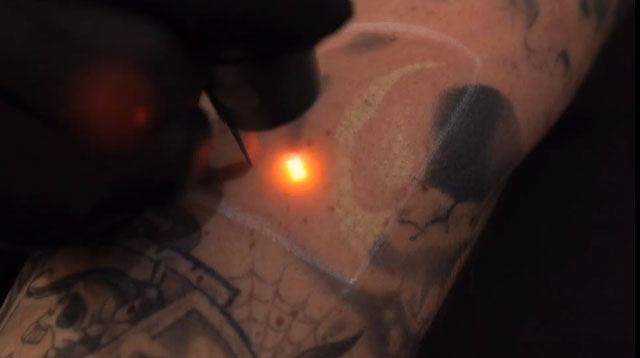 The Latest Technology In Tattoo Removal Is Here