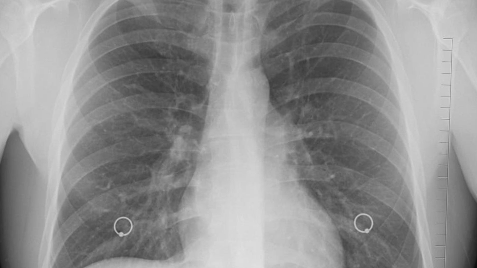 Disease dust lung silica caused by