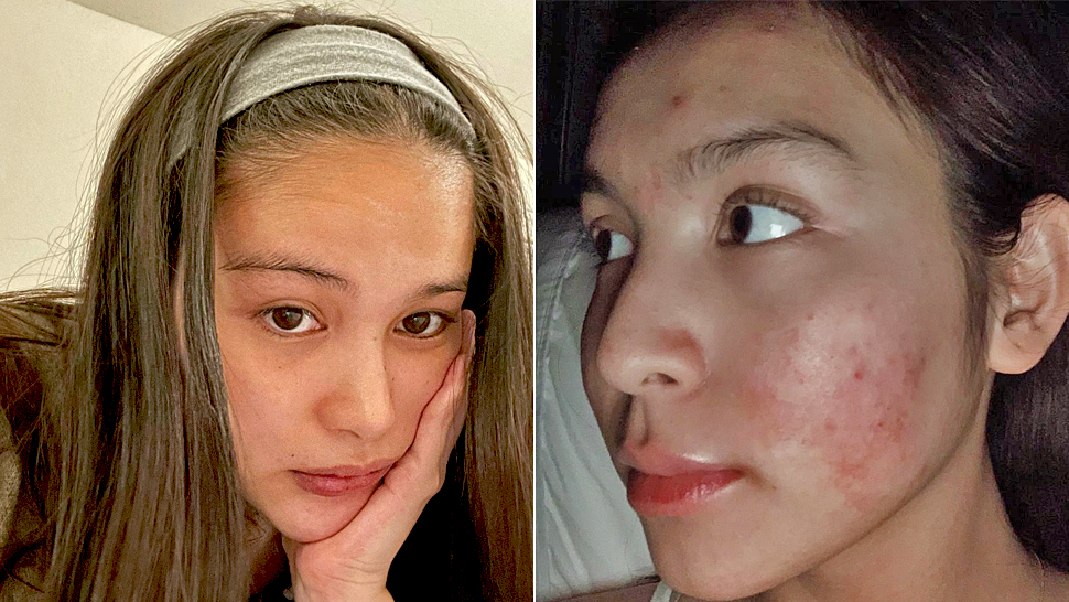 celebrities acne scars