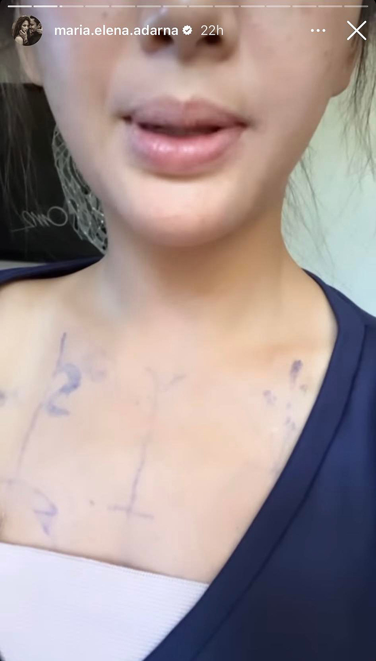 Why Ellen Adarna Chose To Remove Her Breast Implants Preview Ph