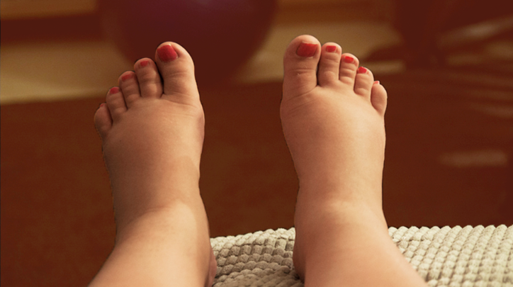Swelling in Pregnancy: How to Prevent and When You Should Worry