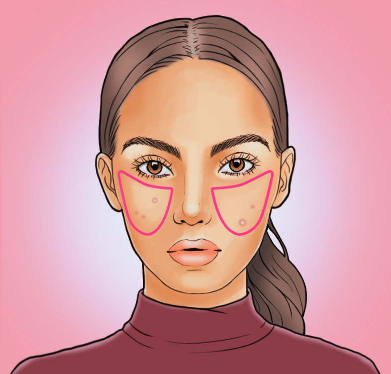 This Acne Chart Will Tell You Why You're Breaking Out