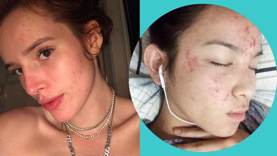 5 Celebrities Who Are Vocal About Their Struggles With Acne