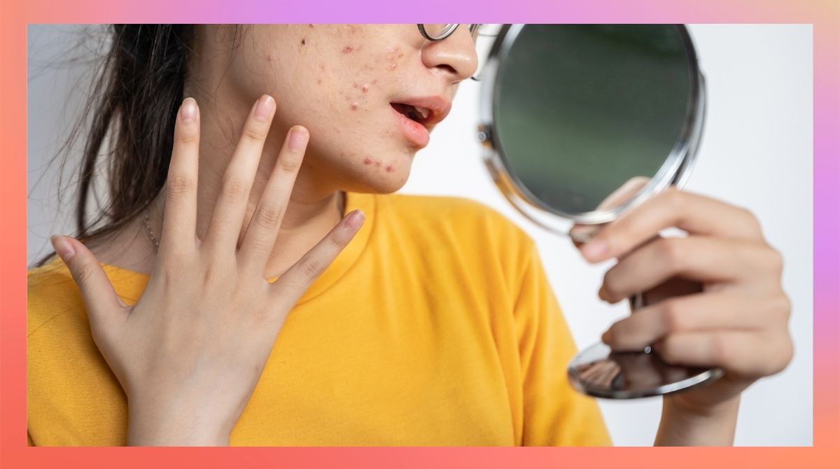 8 Lessons I've Learned From Dealing With Acne-Prone Skin
