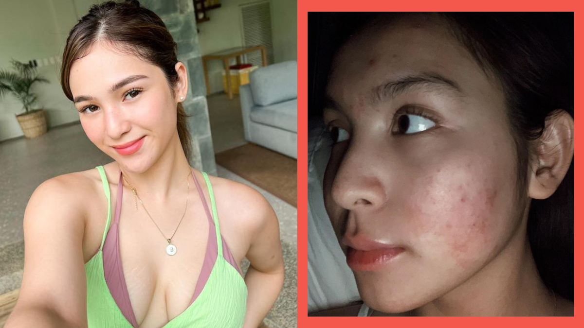 7 Inspiring Gen Z Celebrities Who Opened Up About Their Skin Insecurities