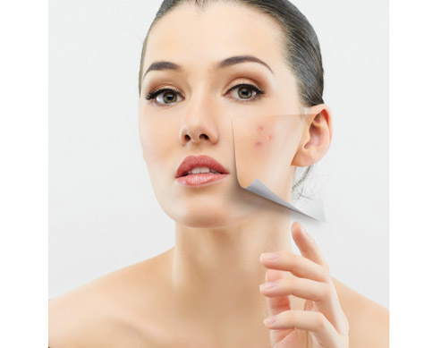 Pimple Treatment from SkinTrends | Candymag.com