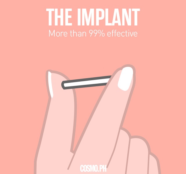 implant, birth control