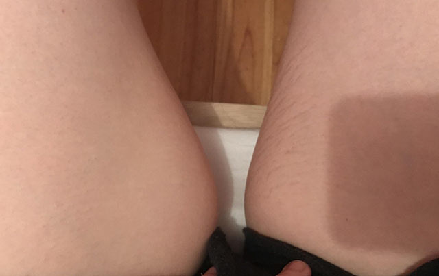 Micro-needling treatment results on the inner left thigh