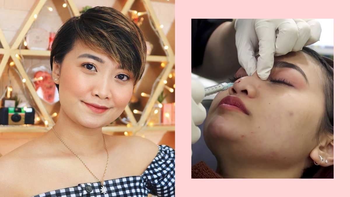 YouTube Vlogger Mae Layug Got A 5-Minute Nose Job