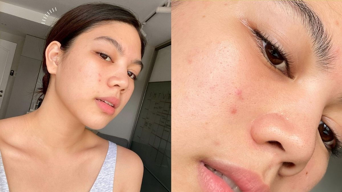 Janina Vela Opens Up About Her Acne Journey