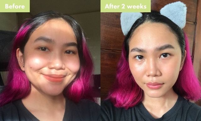 Cheska Santiago's before and after comparison after using Hello Glow's Acne Defense Set