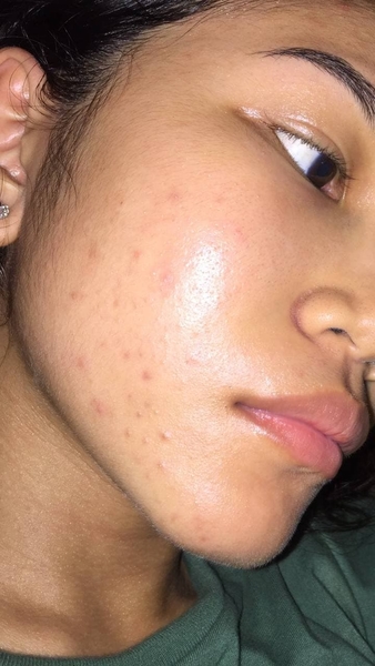 Cheska Santiago having acne breakouts