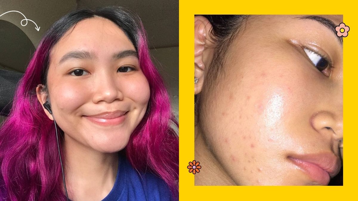 acne acceptance beauty essay, having acne is okay