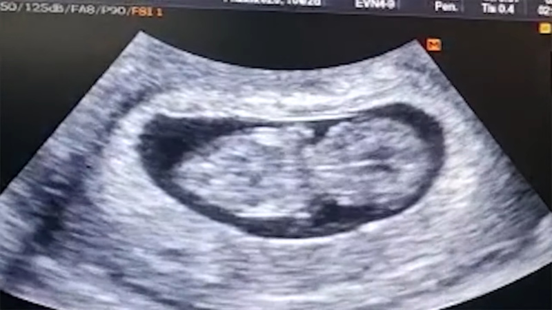 Katarina Rodriguez baby ultrasound