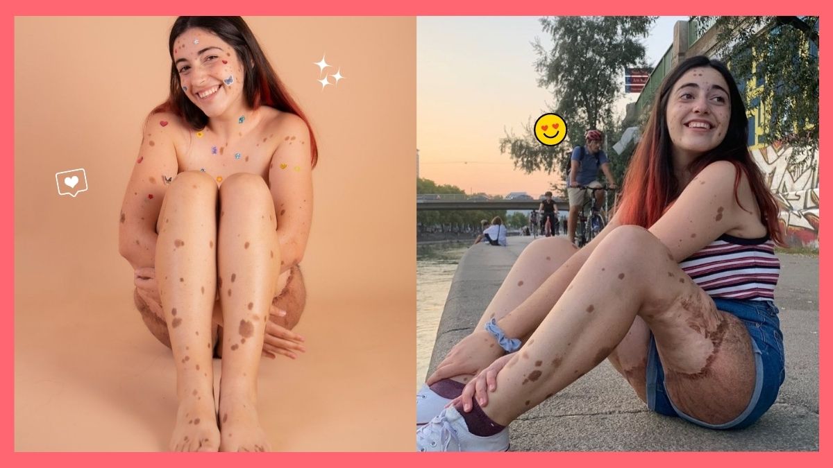 Alba Parejo shares an inspiring message about loving her birthmarks