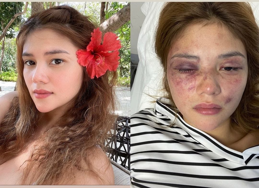Ana Jalandoni injuries after alleged detainment and injury by Kit Thompson