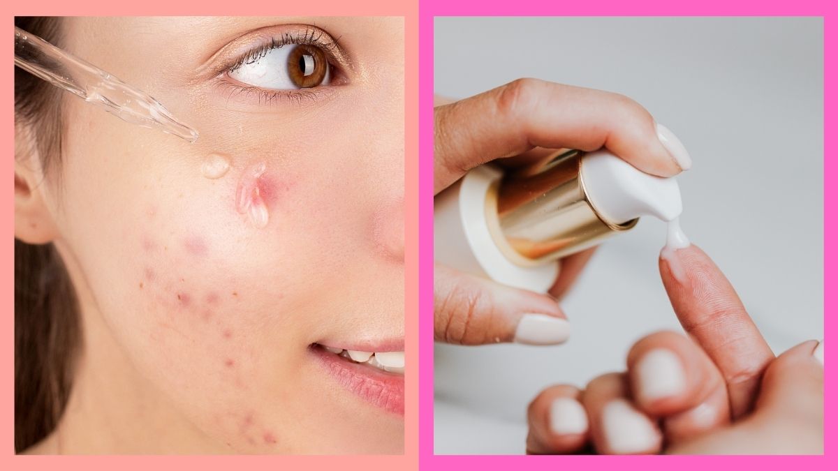 Best Pimple Marks Remover