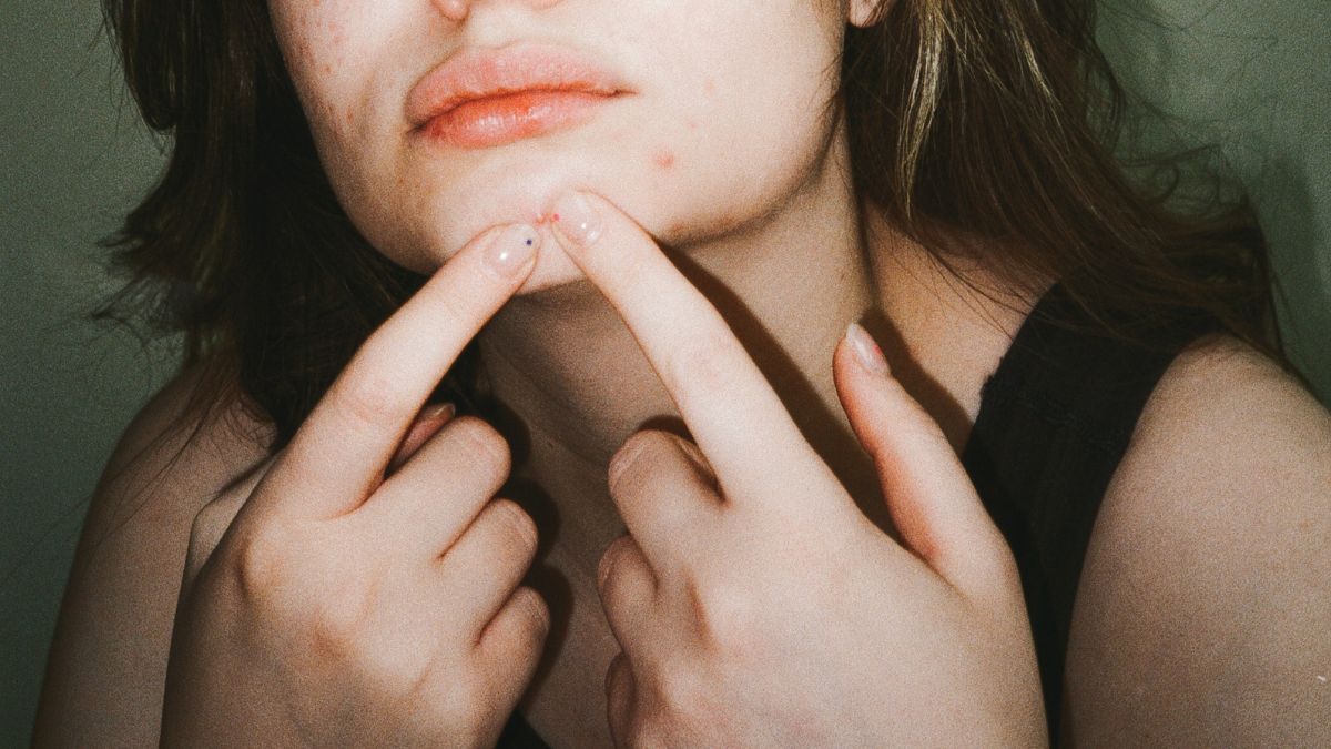 the most common causes of acne