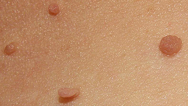 vaginal skin tags vs warts pregnancy