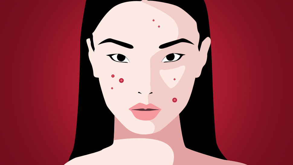 5 Different Types Of Acne And How To Treat Them