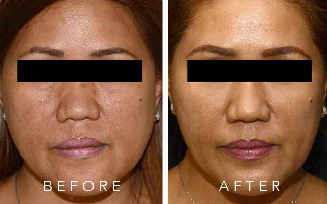 What Causes Double Chin and What You Can Do About It | Preview.ph