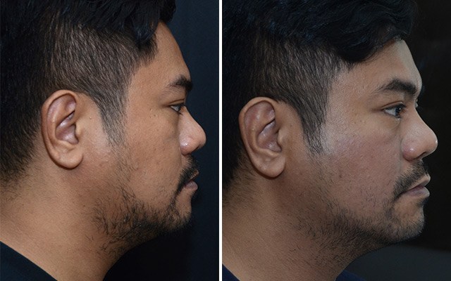 Belo Vcontour Exilis Double Chin Removal Review