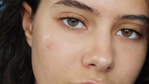 What Are Pimple Patches And What Do They Really Do For Your Acne?