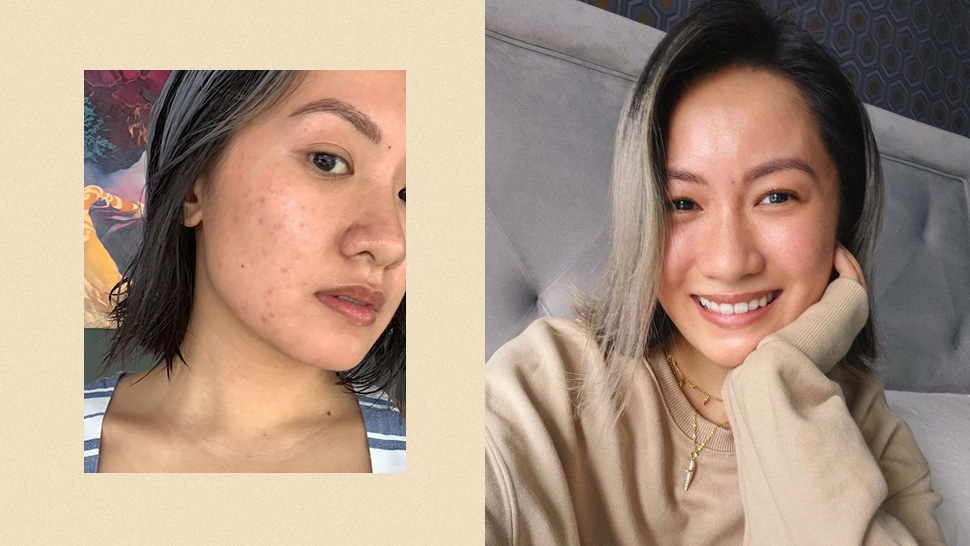 Laureen Uy Shares The Shocking Story Behind Her Worst Acne Breakout
