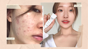 How To Get Glass Skin If You're Acne-prone, According To A Korean Makeup Artist