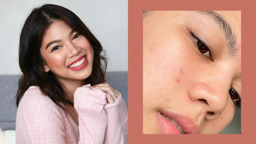 Janina Vela Reminds Us That Acne And Enlarged Pores Are Completely Normal