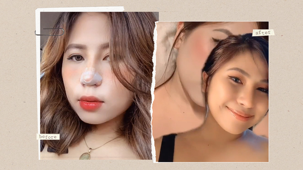 Filipino Netizens Are Showing Off Their Nose Jobs Online And The Results Are Jaw-dropping