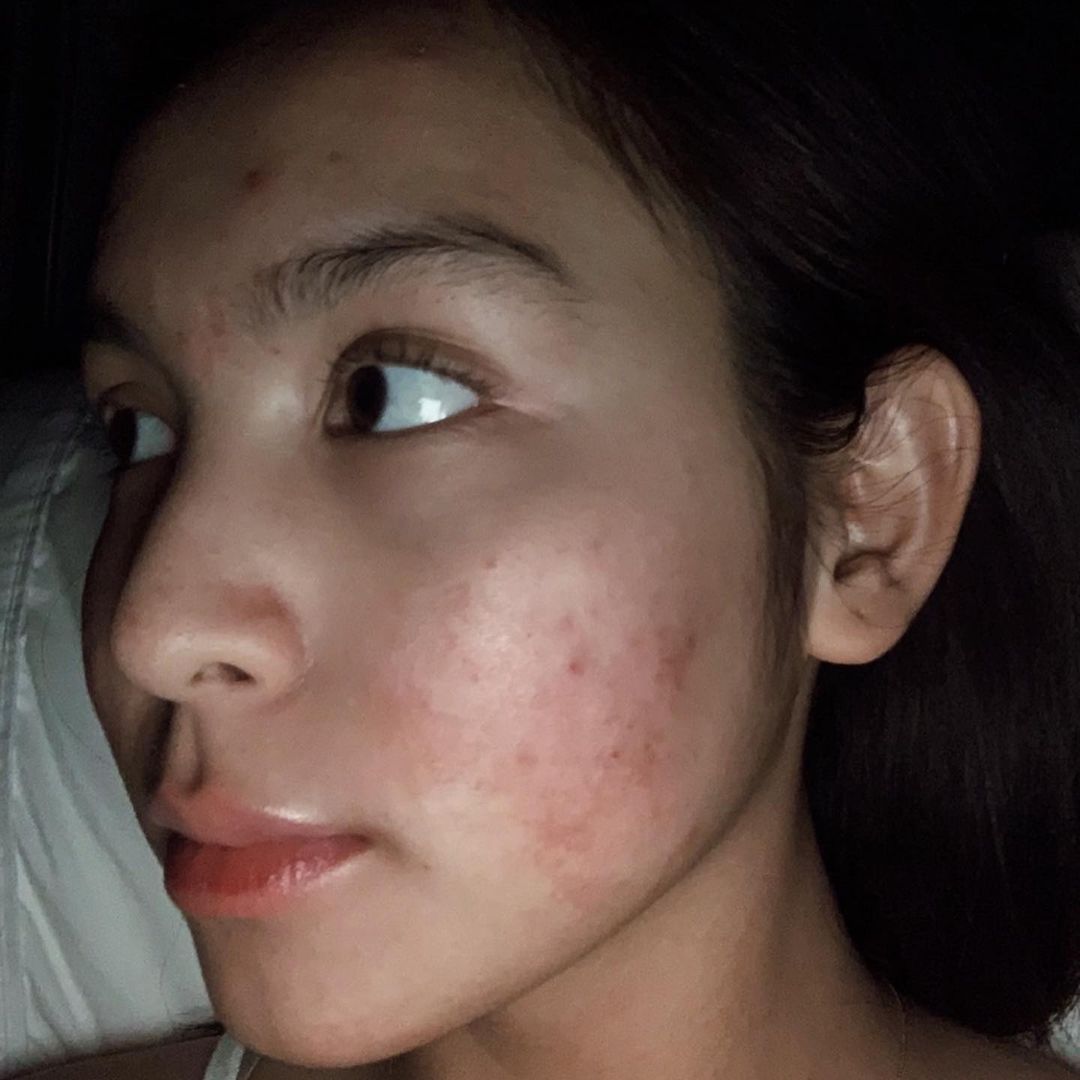 celebrities with acne