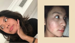 5 Celebrities Who Have Gotten Real About Their Struggles With Acne