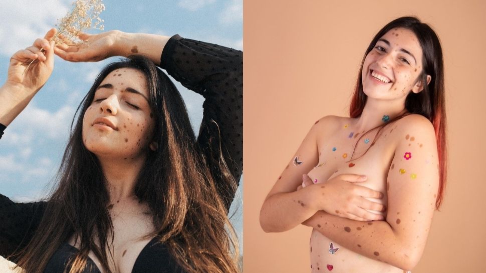 This Model Sends an Inspiring Message Through Baring Her Birthmarks