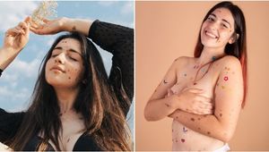 This Model Sends An Inspiring Message Through Baring Her Birthmarks