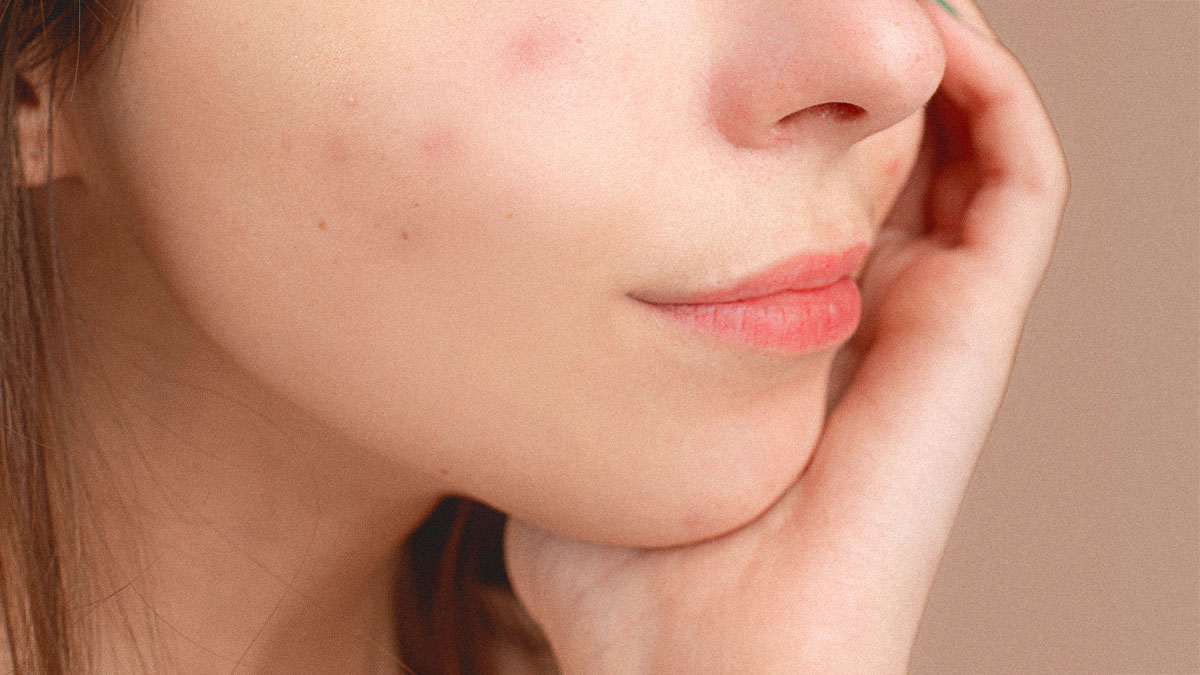 8 Common Causes Of Acne And How To Prevent Them