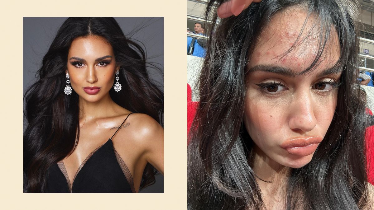Celeste Cortesi Opens Up About Her Acne Breakout After the Miss Universe Competition