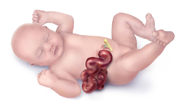 Doctors are Alarmed at the Increasing Incidence of the Birth Defect Gastroschisis