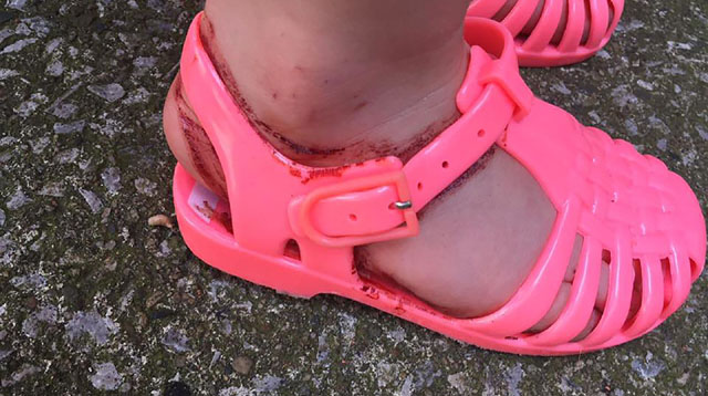 Mom Shares Photos of Her Toddler's Bloody Foot After Wearing New Jelly Sandals
