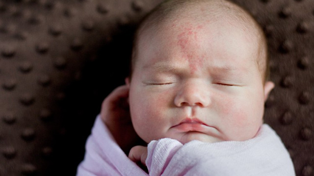 A Parent's Quick Guide to Birthmarks