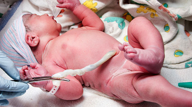 U.S. Ob-Gyn Group Updates Recommendation on Cord Clamping