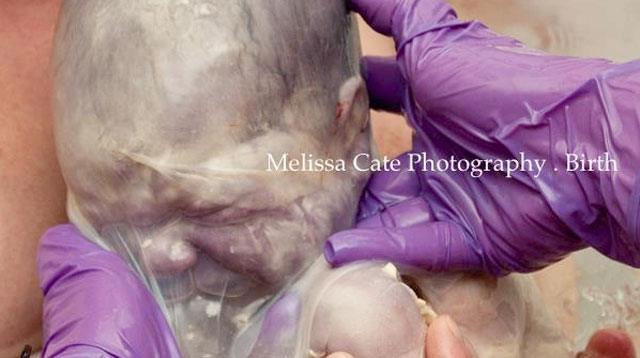LOOK: Baby Born With Amniotic Sac Draped Over His Head and Torso