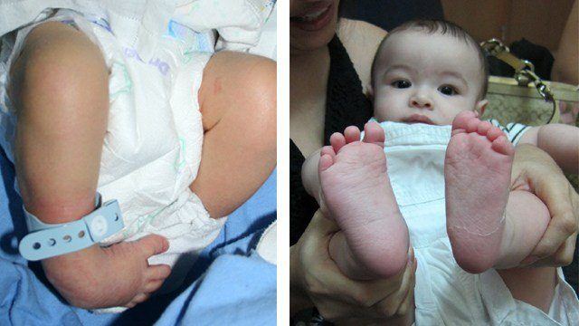 This Dad Is Glad He Got a Second Opinion on His Son's Clubfoot
