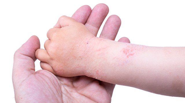 Eczema Quick Guide: What You Need to Know From Diagnosis to Treatment