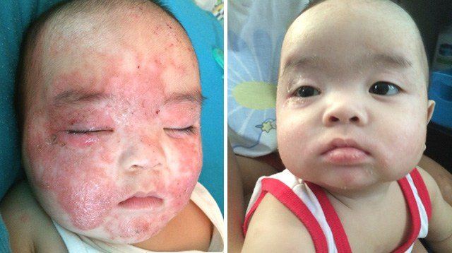 A Mom's Battle and Victory Against Her Baby's Eczema