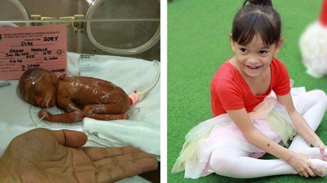 This Girl Weighed 1 Pound at Birth and Was Given an Hour to Live